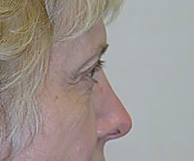 eyelid-lift-blepharoplasty-plastic-surgery-rancho-cucamonga-woman-before-side-dr-maan-kattash