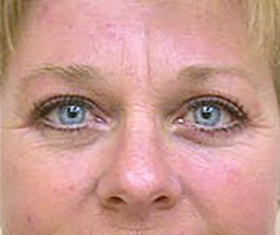 eyelid-lift-blepharoplasty-plastic-surgery-tustin-woman-after-front-dr-maan-kattash