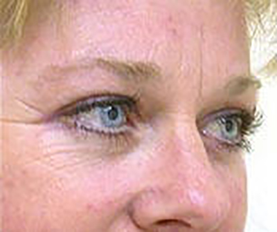 eyelid-lift-blepharoplasty-plastic-surgery-tustin-woman-after-oblique-dr-maan-kattash