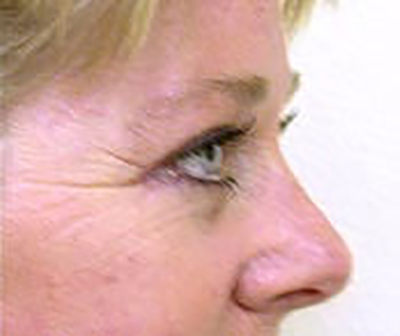 eyelid-lift-blepharoplasty-plastic-surgery-tustin-woman-after-side-dr-maan-kattash