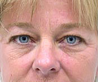 eyelid-lift-blepharoplasty-plastic-surgery-tustin-woman-before-front-dr-maan-kattash