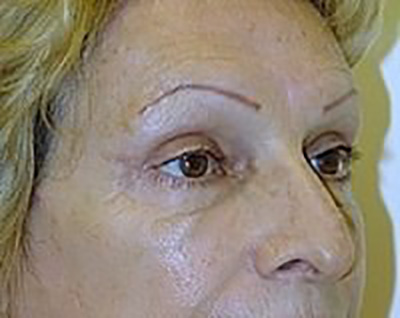 eyelid-lift-blepharoplasty-plastic-surgery-upland-after-oblique-dr-maan-kattash