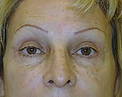 eyelid-lift-blepharoplasty-plastic-surgery-upland-woman-after-front-dr-maan-kattash