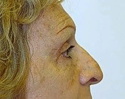 eyelid-lift-blepharoplasty-plastic-surgery-upland-woman-after-side-dr-maan-kattash