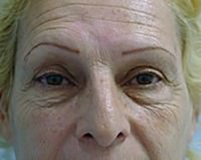 eyelid-lift-blepharoplasty-plastic-surgery-upland-woman-before-front-dr-maan-kattash