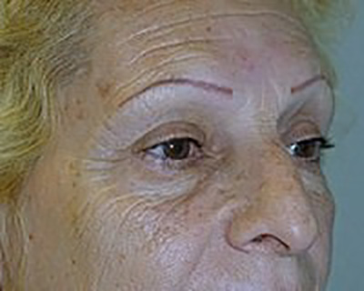 eyelid-lift-blepharoplasty-plastic-surgery-upland-woman-before-oblique-dr-maan-kattash