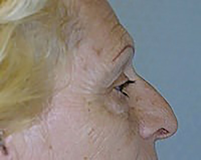eyelid-lift-blepharoplasty-plastic-surgery-upland-woman-before-side-dr-maan-kattash