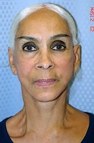 facelift-mini-plastic-surgery-beverly-hills-woman-after-front-dr-maan-kattash