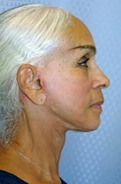 facelift-mini-plastic-surgery-beverly-hills-woman-after-side-dr-maan-kattash