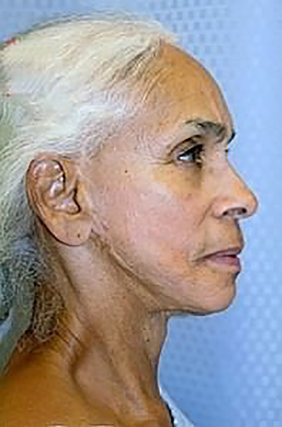 facelift-mini-plastic-surgery-beverly-hills-woman-before-side-dr-maan-kattash