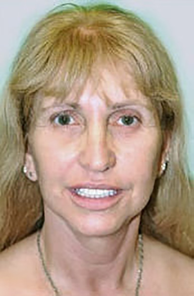 facelift-plastic-surgery-irvine-woman-after-front-dr-maan-kattash