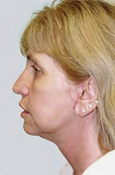 facelift-plastic-surgery-irvine-woman-after-side-dr-maan-kattash
