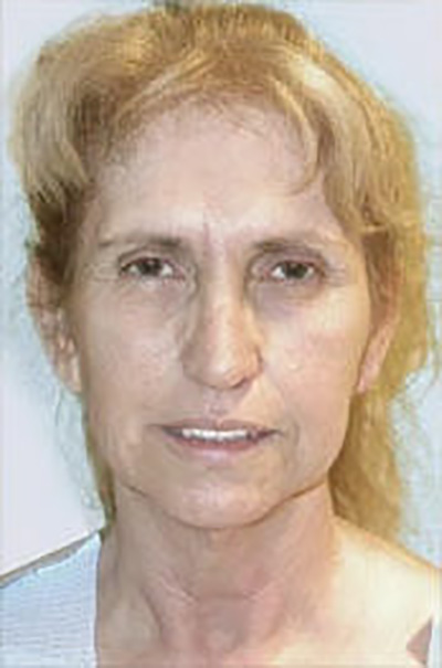 facelift-plastic-surgery-irvine-woman-before-front-dr-maan-kattash