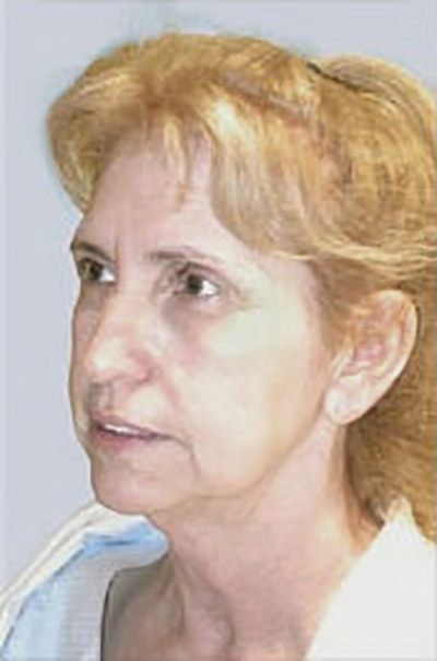 facelift-plastic-surgery-irvine-woman-before-oblique-dr-maan-kattash