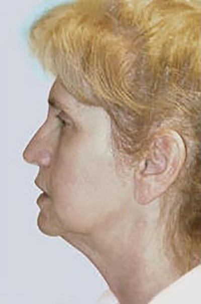 facelift-plastic-surgery-irvine-woman-before-side-dr-maan-kattash