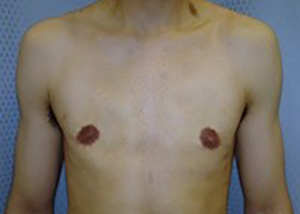 gynecomastia-male-breast-reduction-surgery-beverly-hills-after-front-dr-maan-kattash-2