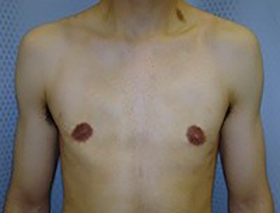 gynecomastia-male-breast-reduction-surgery-beverly-hills-after-front-dr-maan-kattash-2
