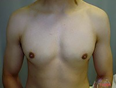 gynecomastia-male-breast-reduction-surgery-beverly-hills-before-front-dr-maan-kattash-2