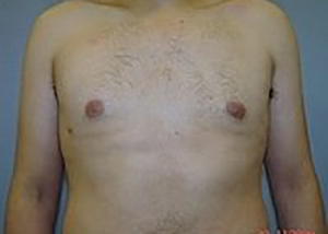 gynecomastia-male-breast-reduction-surgery-claremont-after-front-dr-maan-kattash