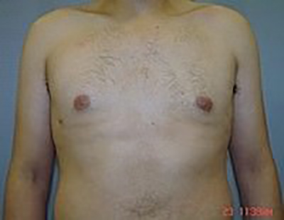 gynecomastia-male-breast-reduction-surgery-claremont-after-front-dr-maan-kattash