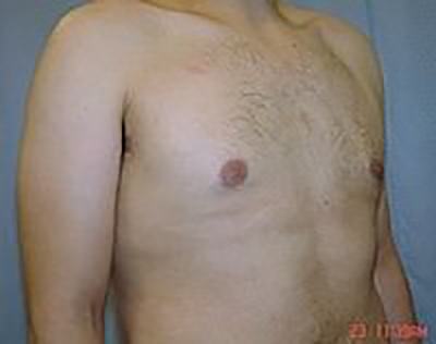 gynecomastia-male-breast-reduction-surgery-claremont-after-oblique-dr-maan-kattash