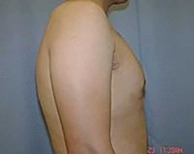 gynecomastia-male-breast-reduction-surgery-claremont-after-side-dr-maan-kattash