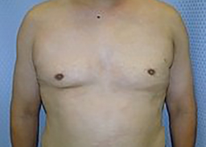 gynecomastia-male-breast-reduction-surgery-los-angeles-after-front-dr-maan-kattash-2