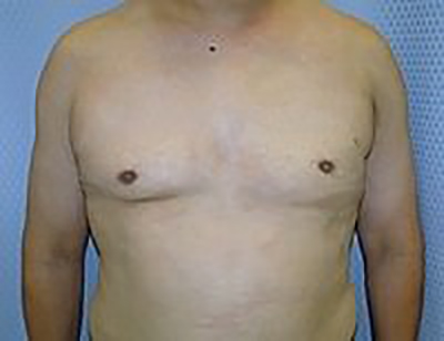 gynecomastia-male-breast-reduction-surgery-los-angeles-after-front-dr-maan-kattash-2