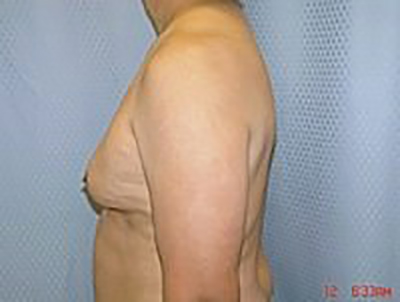gynecomastia-male-breast-reduction-surgery-los-angeles-before-side-dr-maan-kattash-2