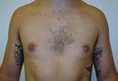 gynecomastia-male-breast-reduction-surgery-ontario-after-front-dr-maan-kattash