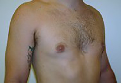 gynecomastia-male-breast-reduction-surgery-ontario-after-oblique-dr-maan-kattash