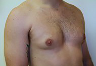 gynecomastia-male-breast-reduction-surgery-ontario-before-oblique-dr-maan-kattash