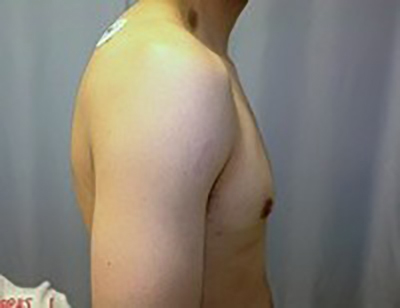 gynecomastia-male-breast-reduction-surgery-ontario-before-side-dr-maan-kattash (2)