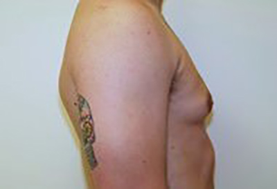 gynecomastia-male-breast-reduction-surgery-ontario-before-side-dr-maan-kattash