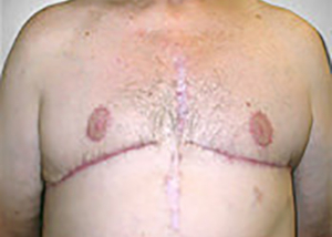 gynecomastia-male-breast-reduction-surgery-upland-after-front-dr-maan-kattash