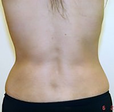 liposuction-plastic-surgery-beverly-hills-woman-woman-after-back-dr-maan-kattash