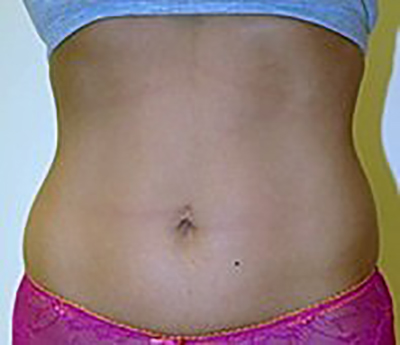 liposuction-plastic-surgery-los-angeles-woman-before-front-dr-maan-kattash