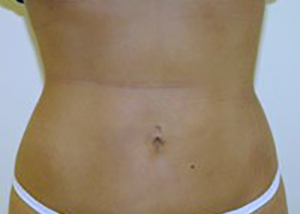 liposuction-plastic-surgery-los-angeles-woman-woman-after-front-dr-maan-kattash