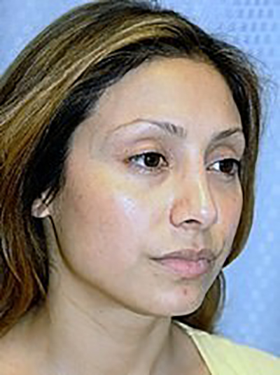 rhinoplasty-plastic-surgery-nose-job-claremont-woman-after-oblique-dr-maan-kattash2
