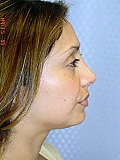 rhinoplasty-plastic-surgery-nose-job-claremont-woman-after-side-dr-maan-kattash2