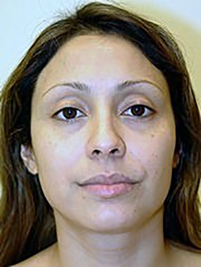 rhinoplasty-plastic-surgery-nose-job-claremont-woman-before-front-dr-maan-kattash2