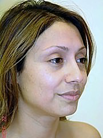 rhinoplasty-plastic-surgery-nose-job-claremont-woman-before-oblique-dr-maan-kattash2