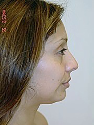 rhinoplasty-plastic-surgery-nose-job-claremont-woman-before-side-dr-maan-kattash2