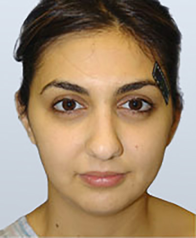 rhinoplasty-plastic-surgery-nose-job-orange-county-woman-before-front-dr-maan-kattash2