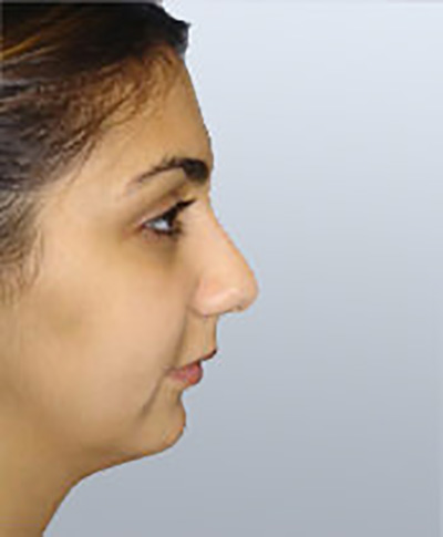 rhinoplasty-plastic-surgery-nose-job-orange-county-woman-before-side-dr-maan-kattash2