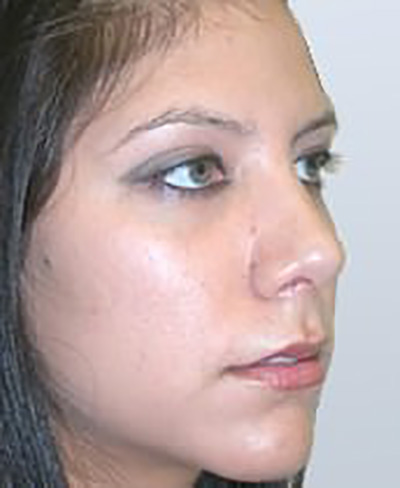 rhinoplasty-plastic-surgery-nose-job-tustin-woman-after-oblique-dr-maan-kattash2