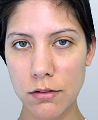 rhinoplasty-plastic-surgery-nose-job-tustin-woman-before-front-dr-maan-kattash2