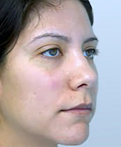 rhinoplasty-plastic-surgery-nose-job-tustin-woman-before-oblique-dr-maan-kattash2
