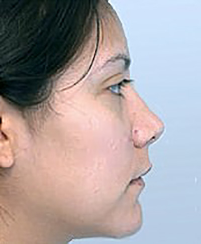 rhinoplasty-plastic-surgery-nose-job-tustin-woman-before-side-dr-maan-kattash2