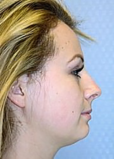 rhinoplasty-plastic-surgery-nose-job-upland-woman-before-side-dr-maan-kattash